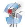 Arthritis